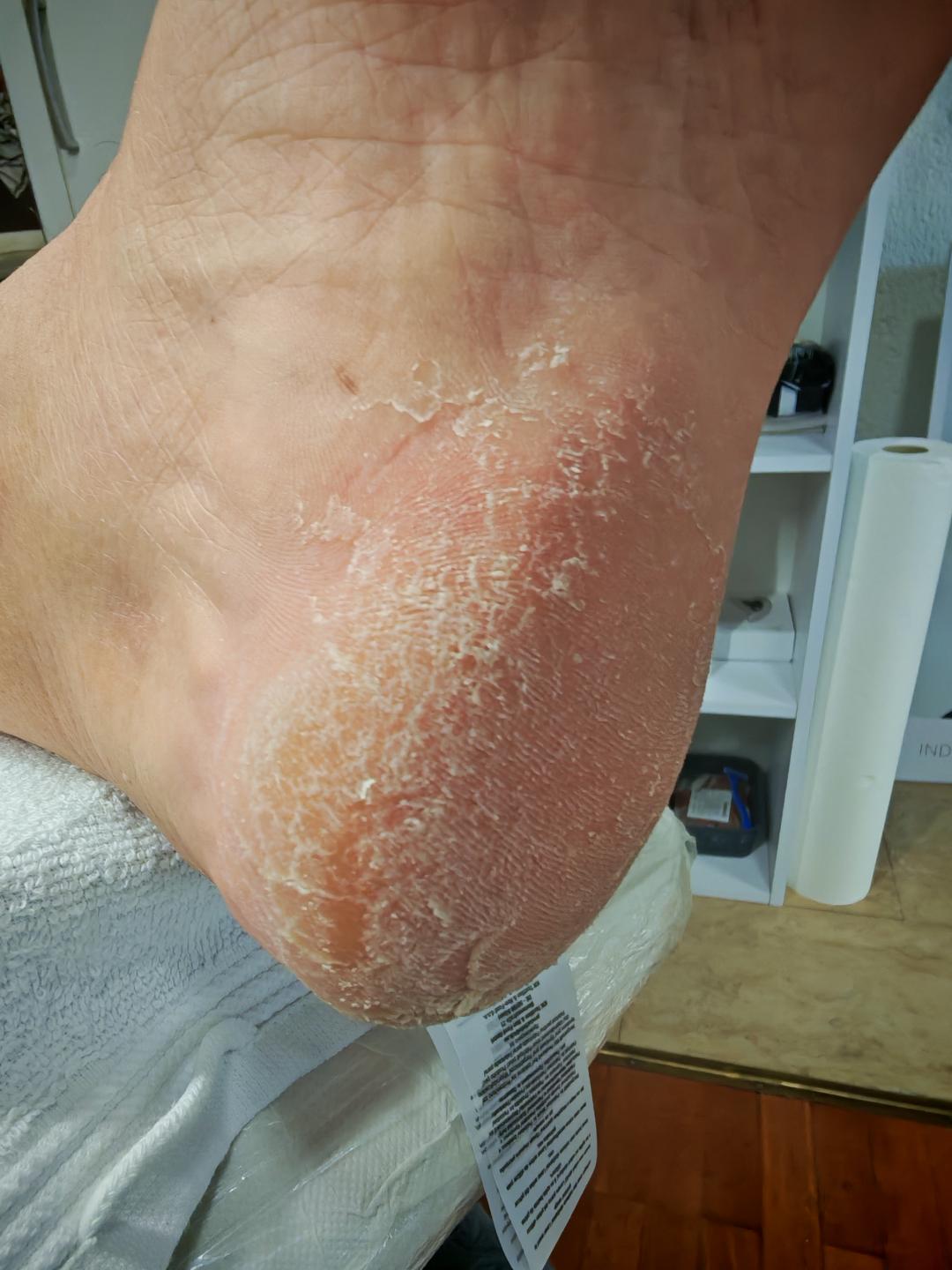 Medicinska pedikura - Skin Care Beauty, Rijeka Medicinska pedikura Nokti Medicinska pedikura, Rijeka, Zamet