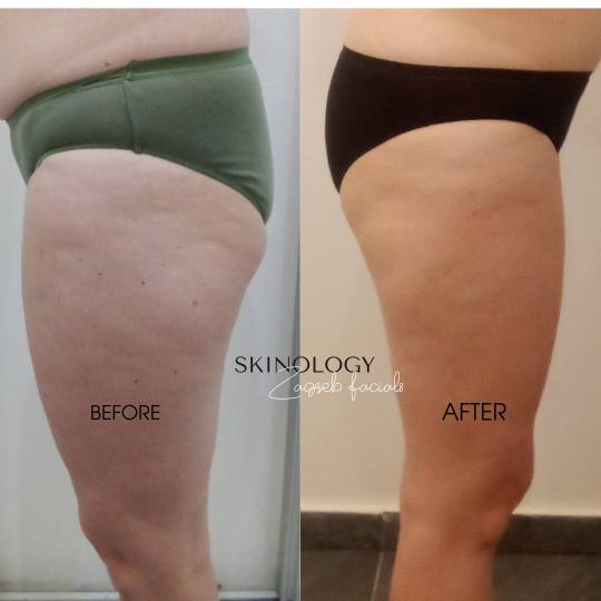 Skinology Zagreb facials #zagreb Tretman lica LPG aparativni anticelulitni tretman - paket od 5 tret