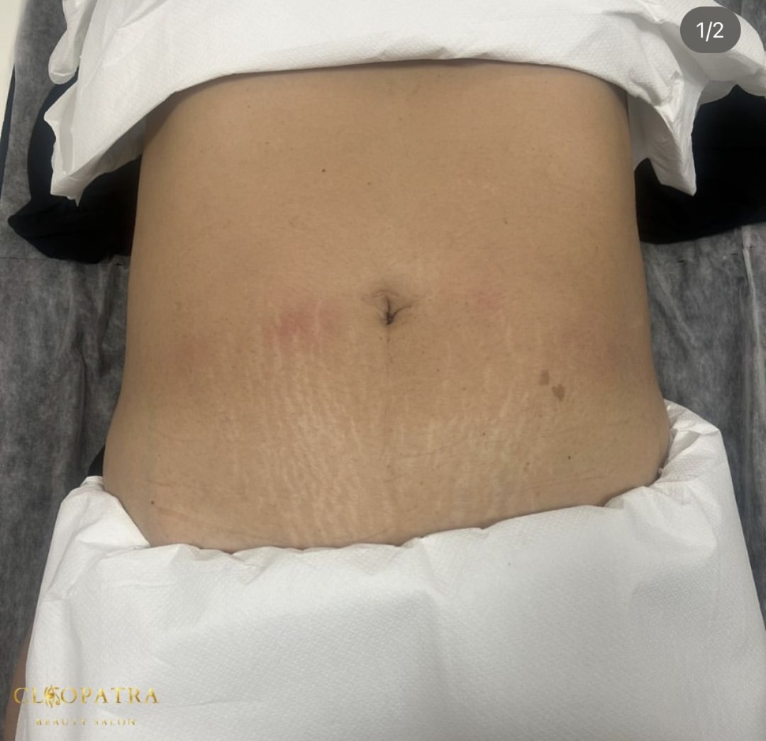 Cleopatra #zagreb Tretmani tijela AKCIJSKI PAKET KAVITACIJA