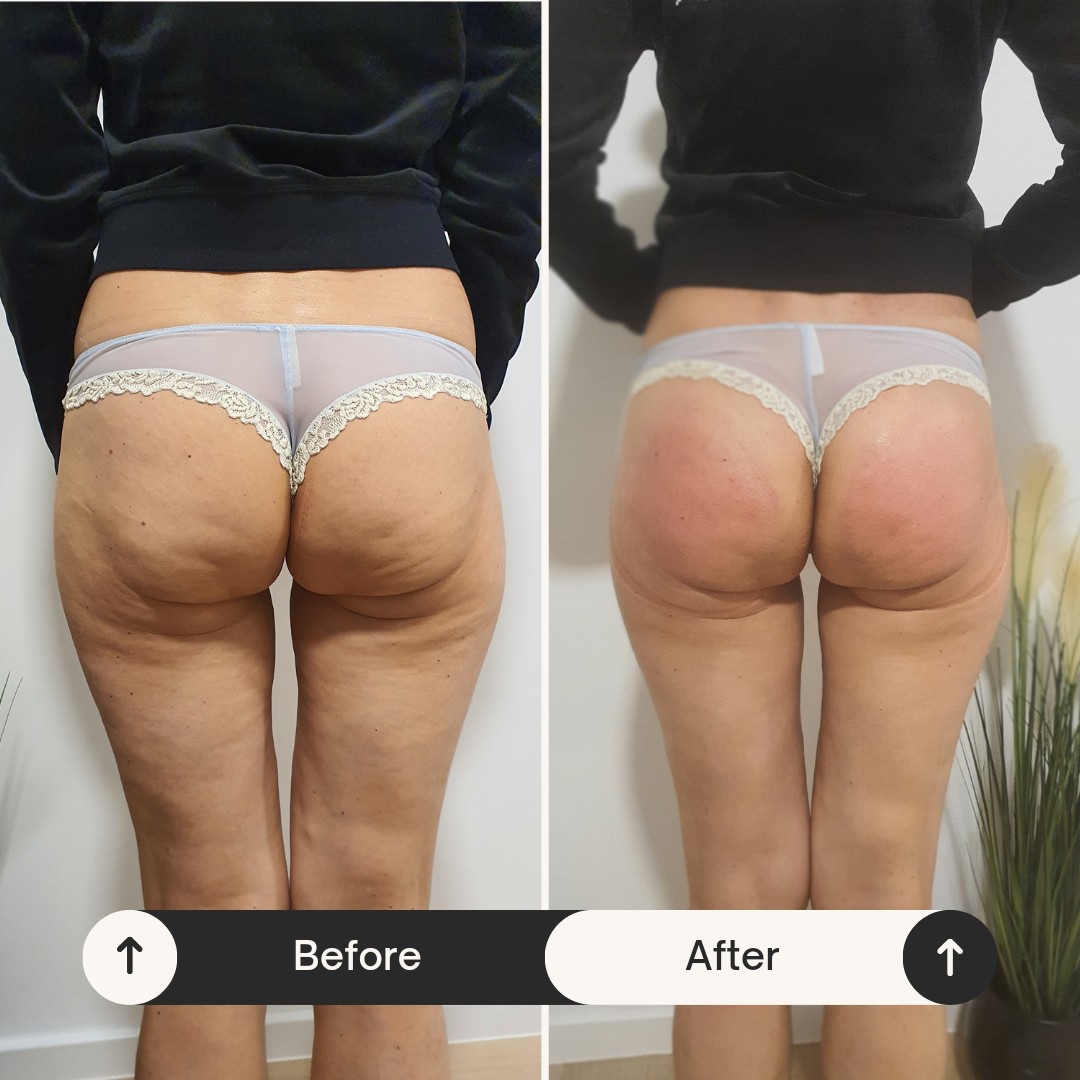 SOLO Beauty Centar #zagreb Tretmani tijela Butt lift vacuum