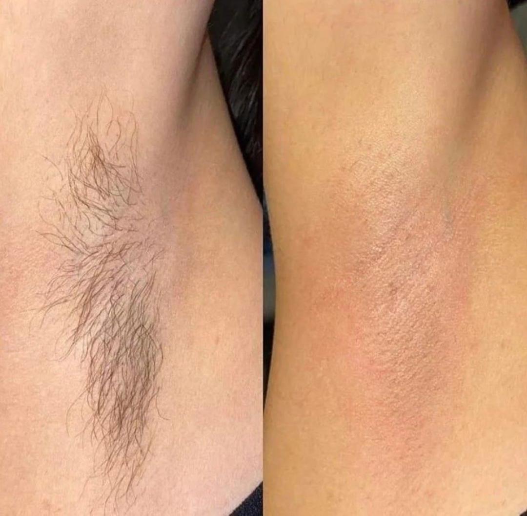 SABRINA STRIJA BEAUTY & SPA #zagreb Depilacija voskom Depilacija pazuha toplim Lycon voskom - za dame