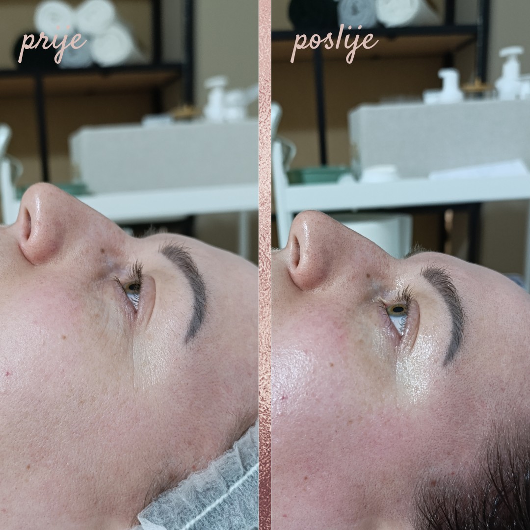 In Statera #zagreb Masaža lica Deep lifting masaža lica + tretman radiofrekvencijom