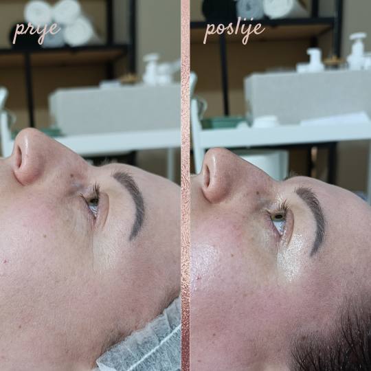 In Statera #zagreb Masaža lica Deep lifting masaža lica + tretman radiofrekvencijom