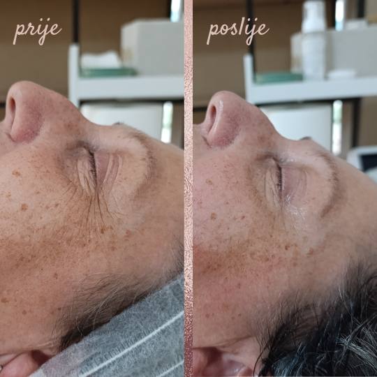 In Statera #zagreb Masaža lica Deep lifting masaža lica + tretman radiofrekvencijom