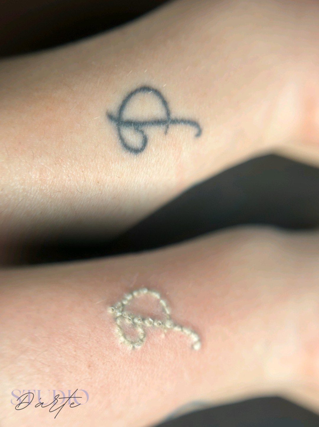 D'Arte Beauty Studio #velika-gorica Uklanjanje tetovaža Lasersko uklanjanje tetovaža - 5x5cm