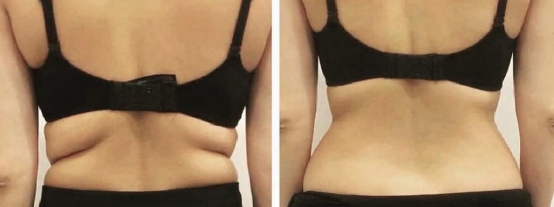 Estetix centar #zagreb Tretmani tijela Lipo laser - paket od 4 tretmana