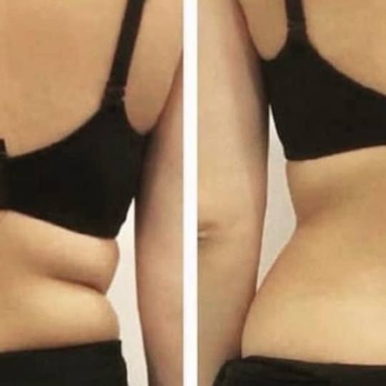 Estetix centar #zagreb Tretmani tijela Lipo laser - paket od 4 tretmana