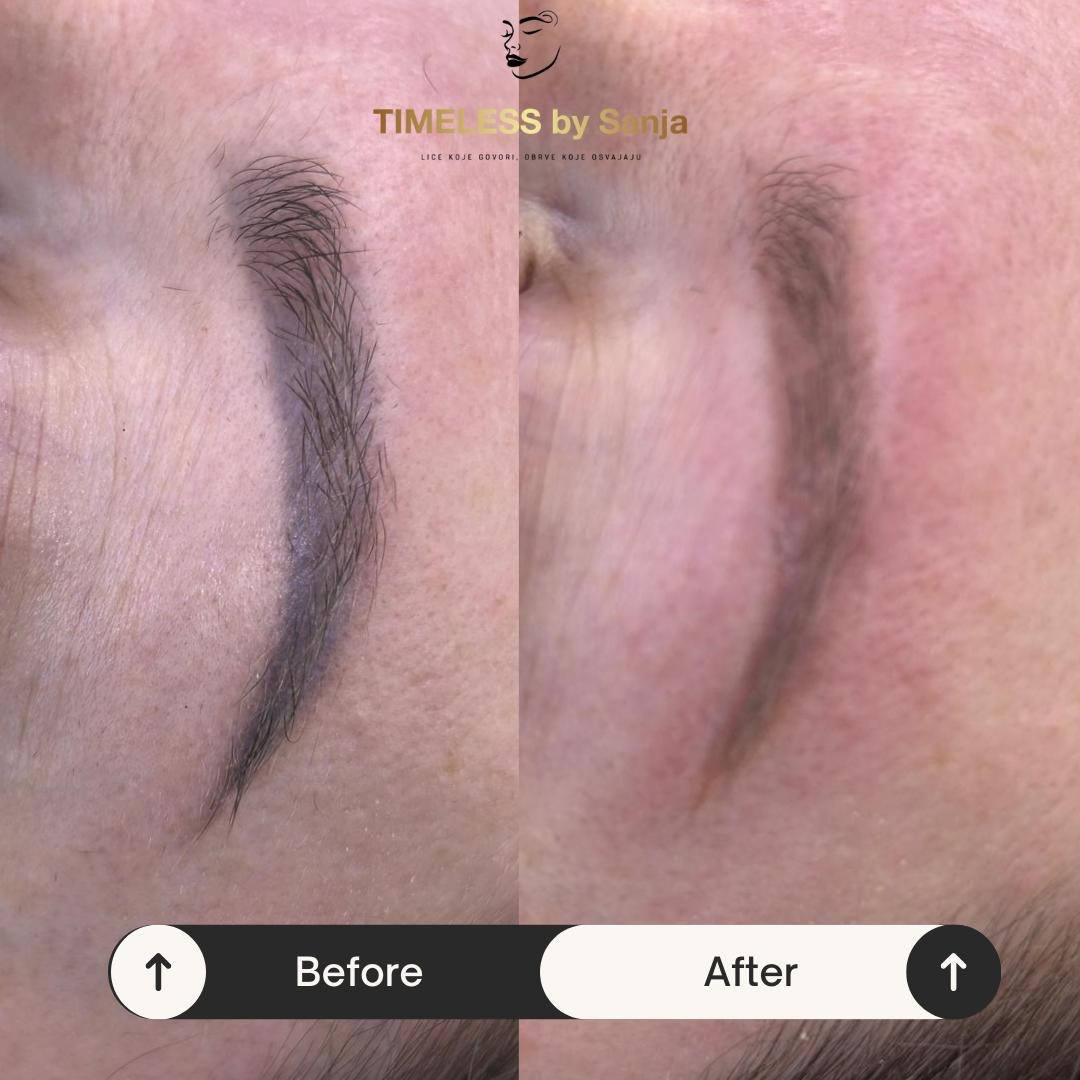 Timeless by Sanja #zagreb Uklanjanje tetovaža Lasersko uklanjanje obrva