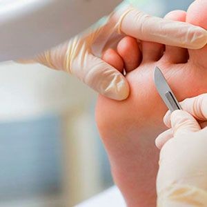 Nails & Beauty Studio #zagreb Medicinska pedikura Medicinska pedikura - manji zahvati