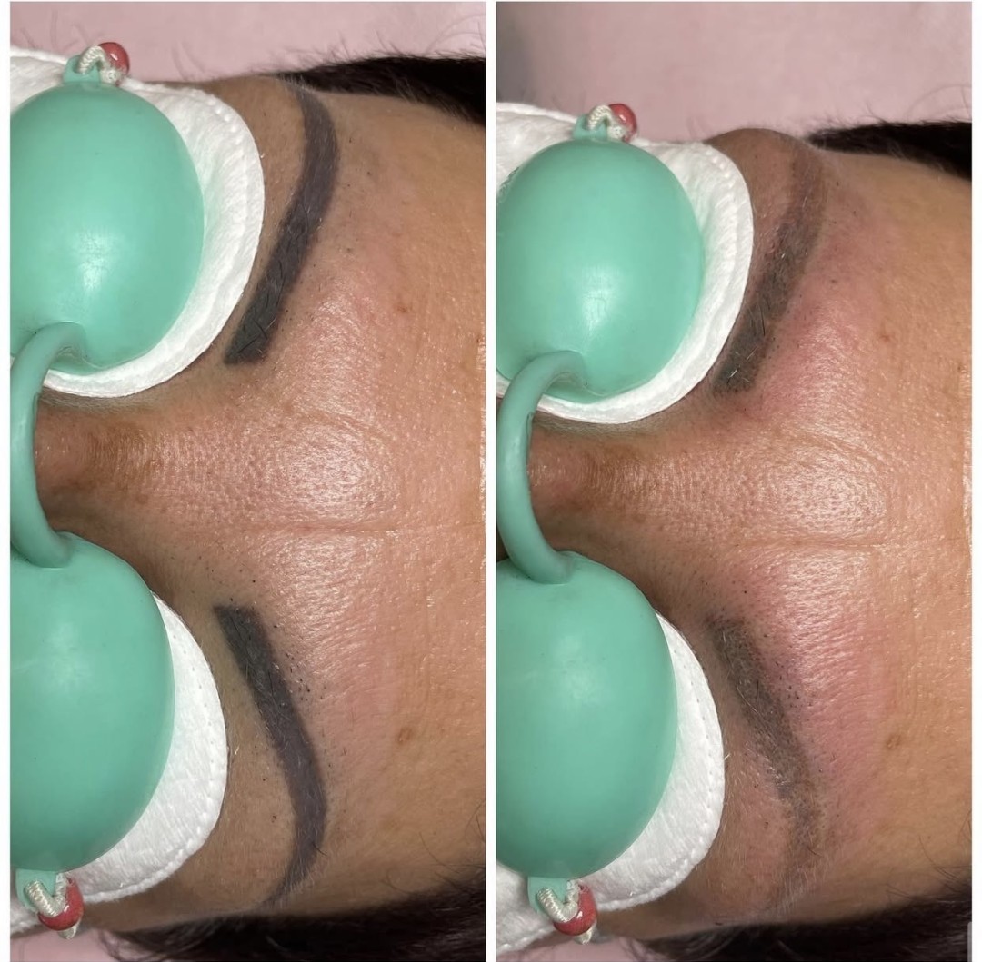 Nefertiti Studio #zagreb Trajna šminka Pico laser za uklanjanje trajne šminke - jedna zona