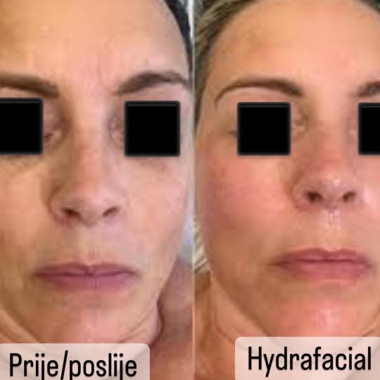 Perfect body beauty bar #zagreb Tretman lica Deluxe hydrafacial tretman lica