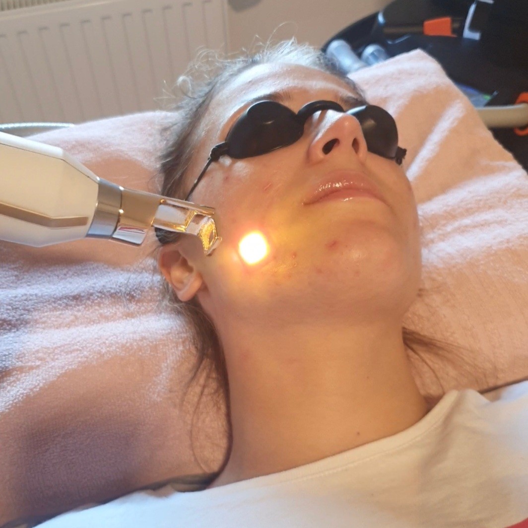 SOLO Beauty Centar #zagreb Laserski tretmani lica Frakcijski laser - tretman podmlađivanja lica