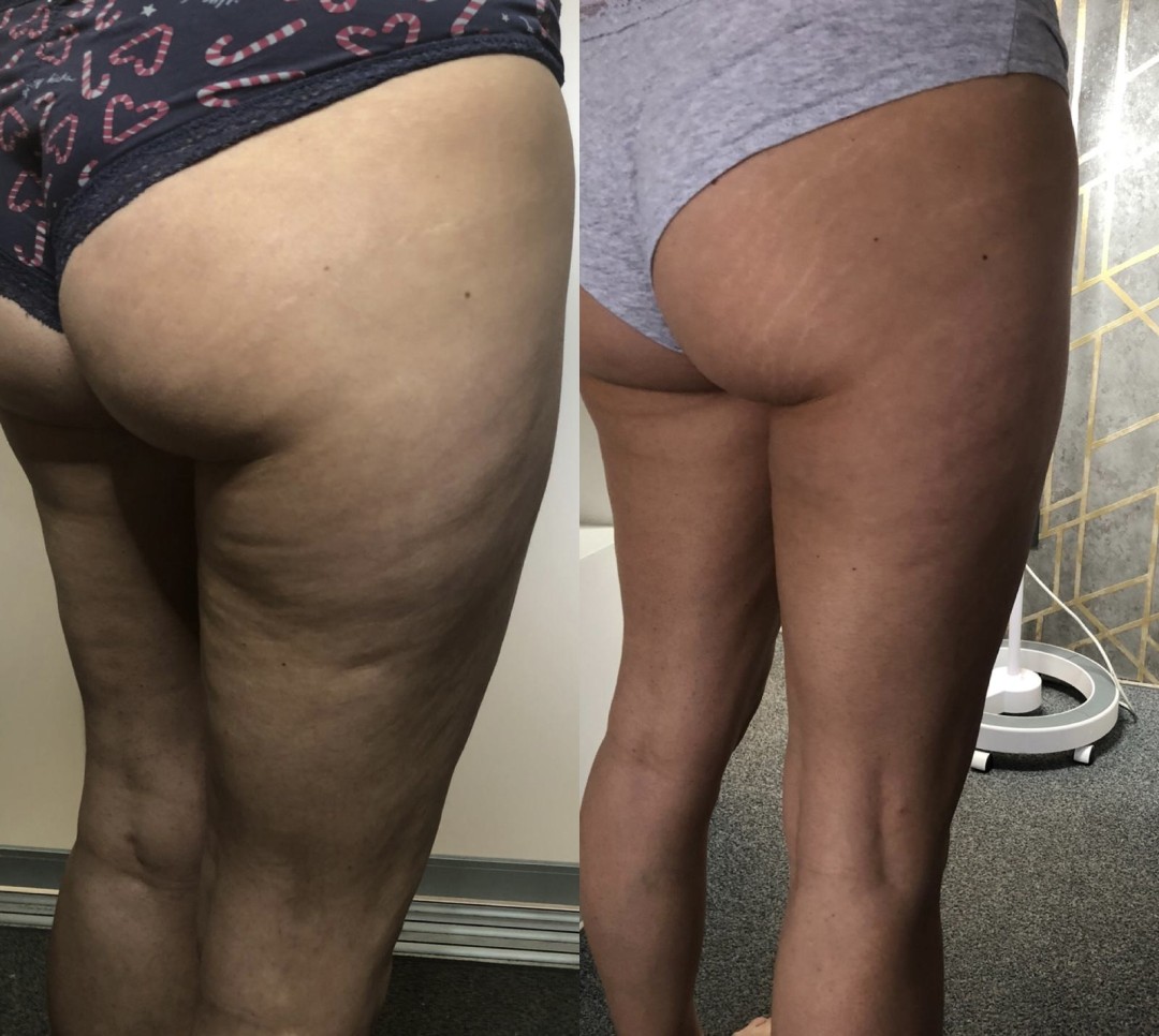 FeelUnique #zagreb Radiovalni i ultrazvučni tretmani LPG oblikovanje + mršavljenje - paket od 10 tretmana + 2 gratis