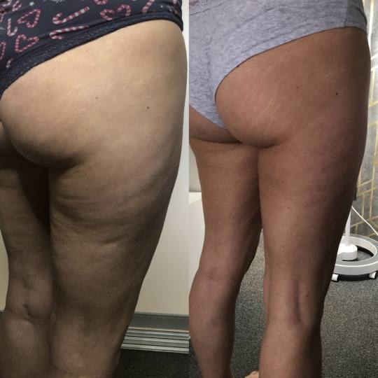 FeelUnique #zagreb Radiovalni i ultrazvučni tretmani LPG oblikovanje + mršavljenje - paket od 10 t