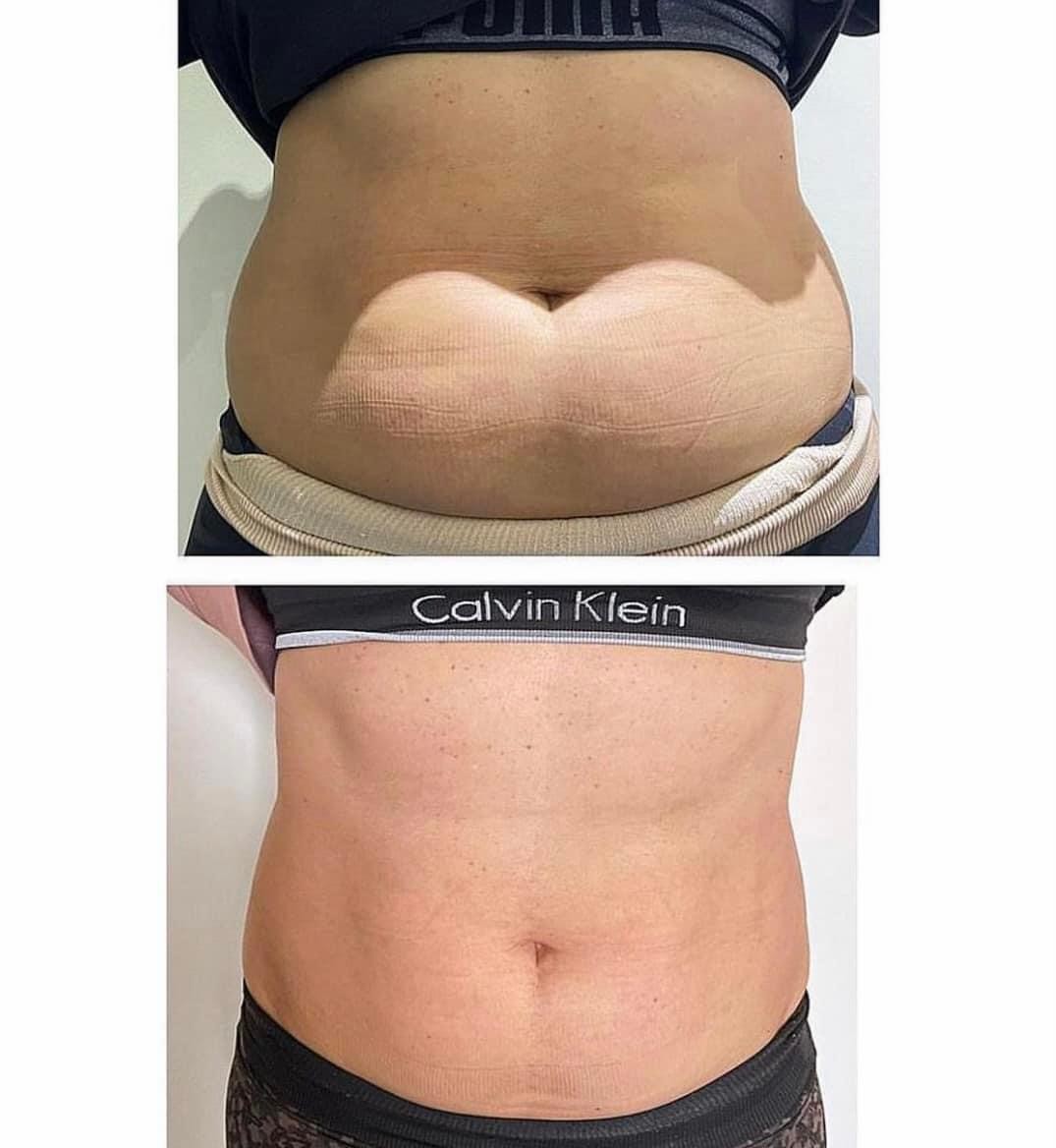 Estetix centar #zagreb Tretmani tijela Emsculpt tretman tijela - paket od 4 tretmana