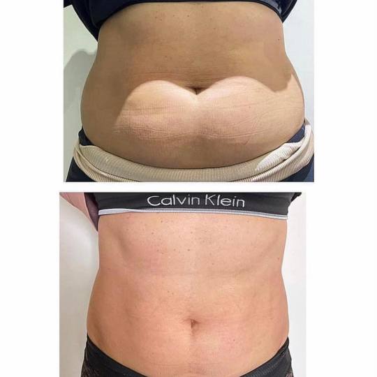 Estetix centar #zagreb Tretmani tijela Emsculpt tretman tijela - paket od 4 tretmana