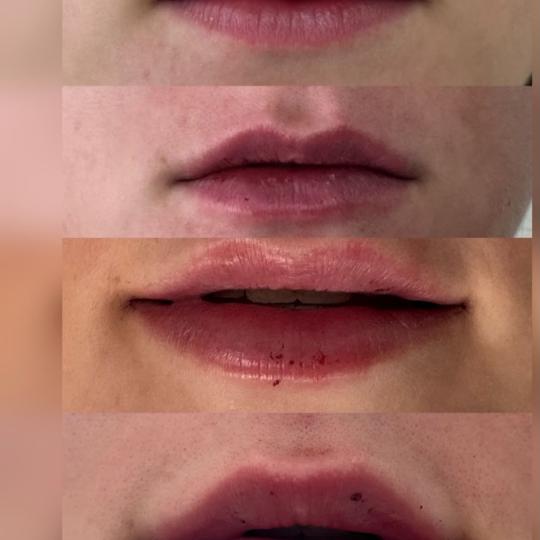 Clinic Burow #split Dermalni fileri Fileri - usne Fileri za usne nježno nadoknađuju volumen, defin