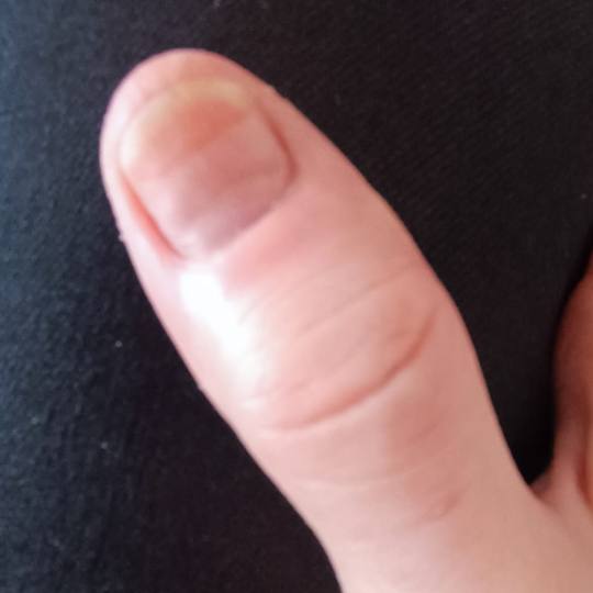 Boba Nail Bar #zagreb Korekcija noktiju Rekonstrukcija nokta / protetika - nokat Nakon skidanja zara