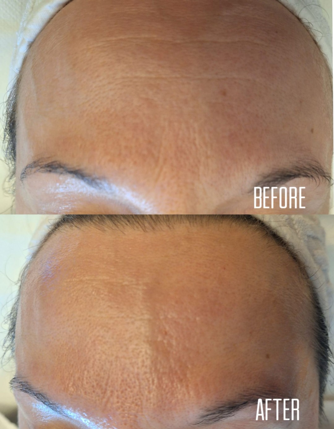 Aura #velika-gorica Tretmani tijela Deluxshape neinvazivno zatezanje lica