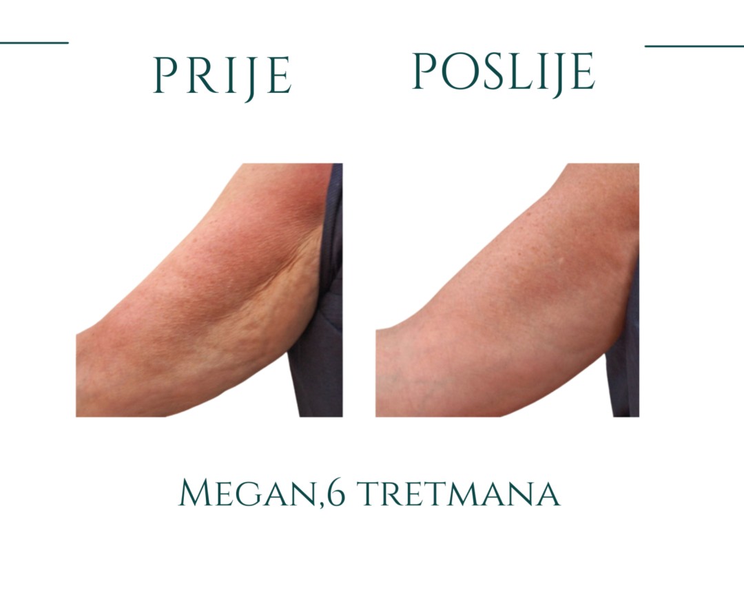 Antiage beauty room Lady Goga #zagreb Tretmani tijela Megan by Skendor - učvršćivanje + preoblikovanje trbuha / nadlaktica / bedara