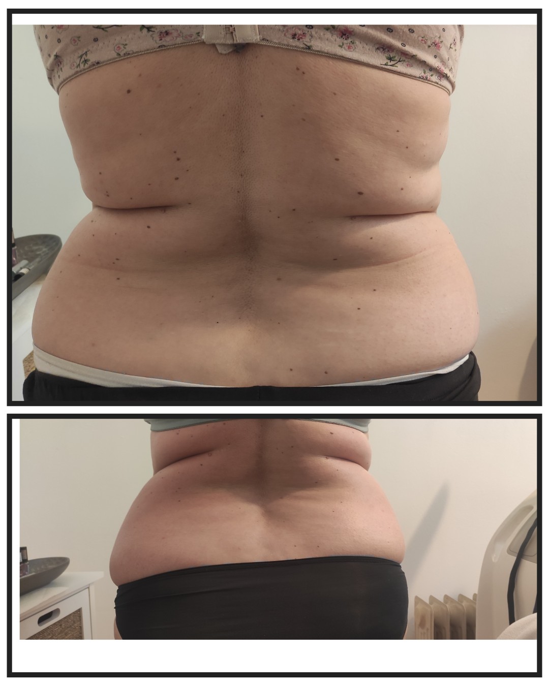 Touch #varazdin Anticelulit masaža Brazilska maderoterapija - parcijalna