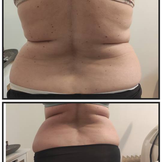 Touch #varazdin Anticelulit masaža Brazilska maderoterapija - parcijalna