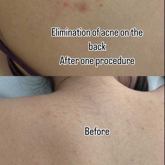 Angela #zagreb Uklanjanje akni na leđima