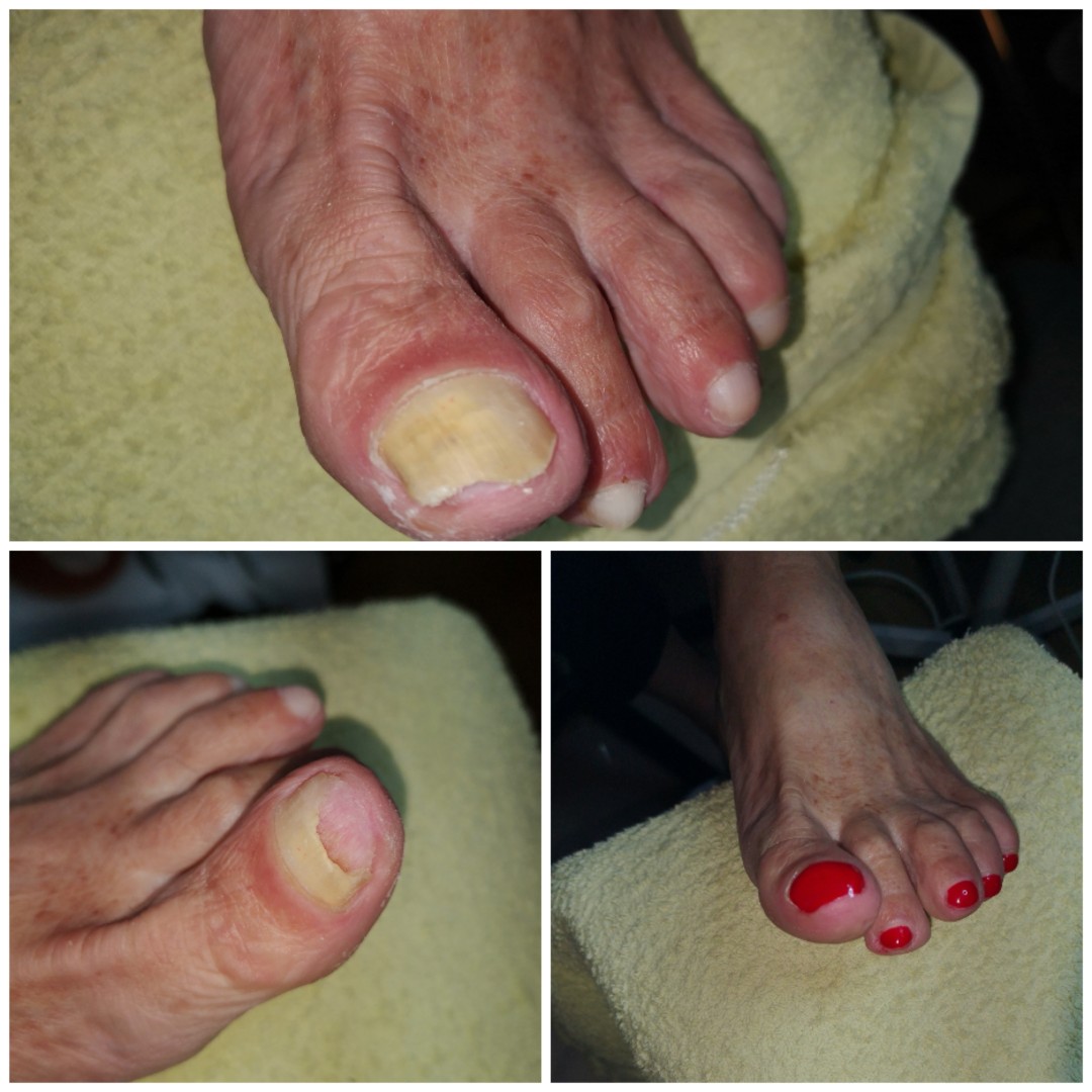 More love beauty #zagreb Medicinska pedikura Medicinska pedikura