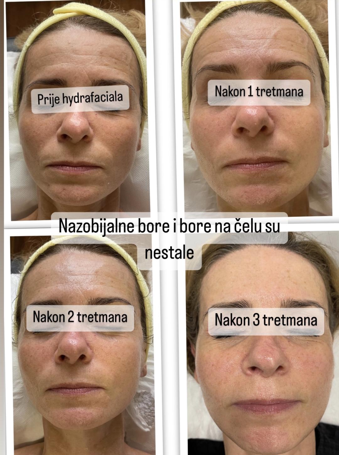 Perfect body beauty bar #zagreb Tretman lica Deluxe hydrafacial tretman lica
