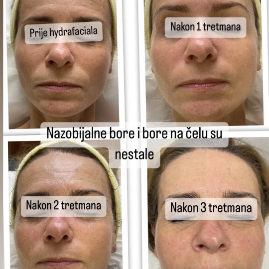 Perfect body beauty bar #zagreb Tretman lica Deluxe hydrafacial tretman lica Kombinacija delux hydra