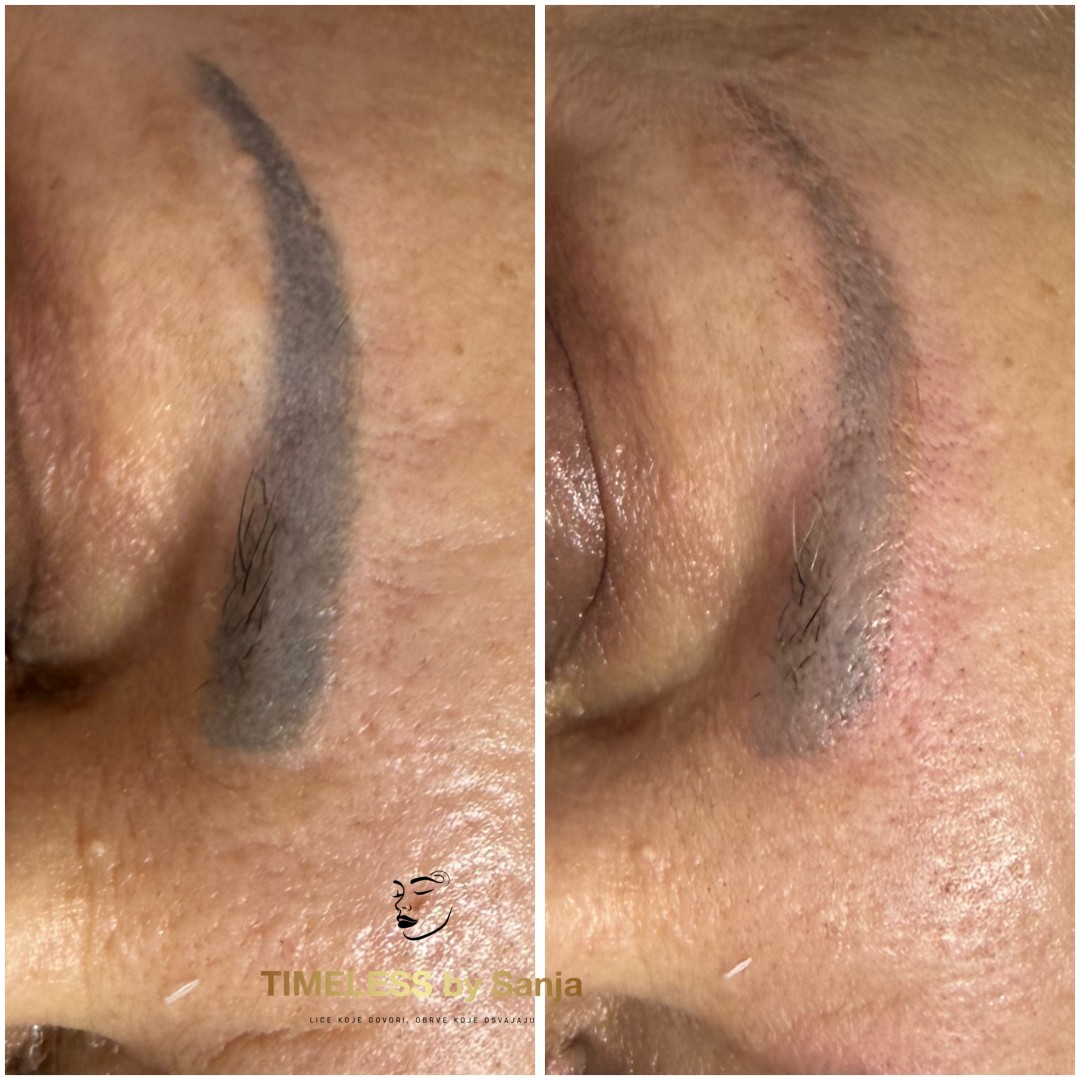 Timeless by Sanja #zagreb Uklanjanje tetovaža Lasersko uklanjanje obrva