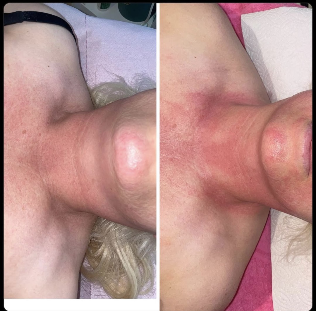 Nefertiti Studio #zagreb Mezoterapija lica Microneedling - lice+vrat+dekolte