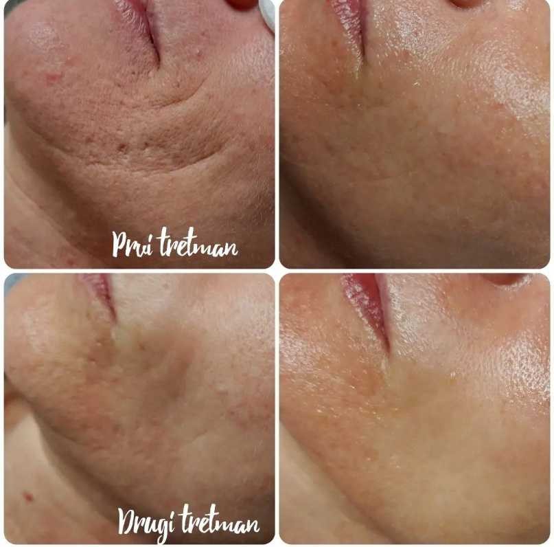 Natural #rijeka Tretman lica Kolagen niti - parcijalno (1 zona)