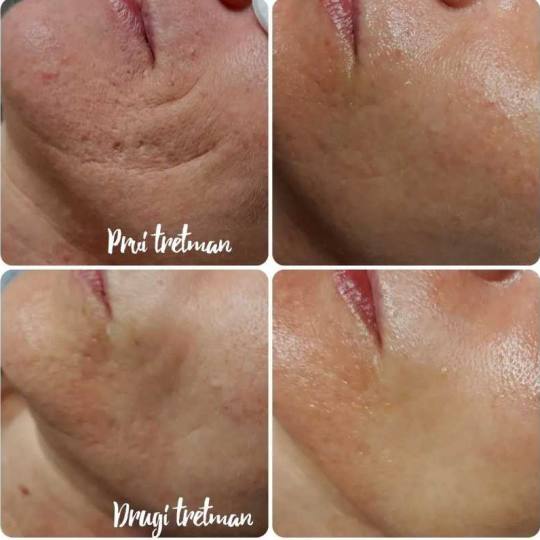 Natural #rijeka Tretman lica Kolagen niti - parcijalno (1 zona)