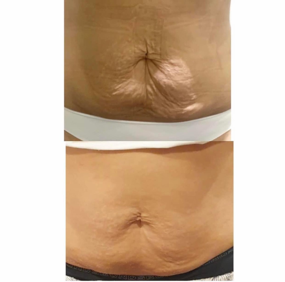 Estetix centar #zagreb Tretmani tijela Indiba 448K tretman tijela - paket od 4 tretmana