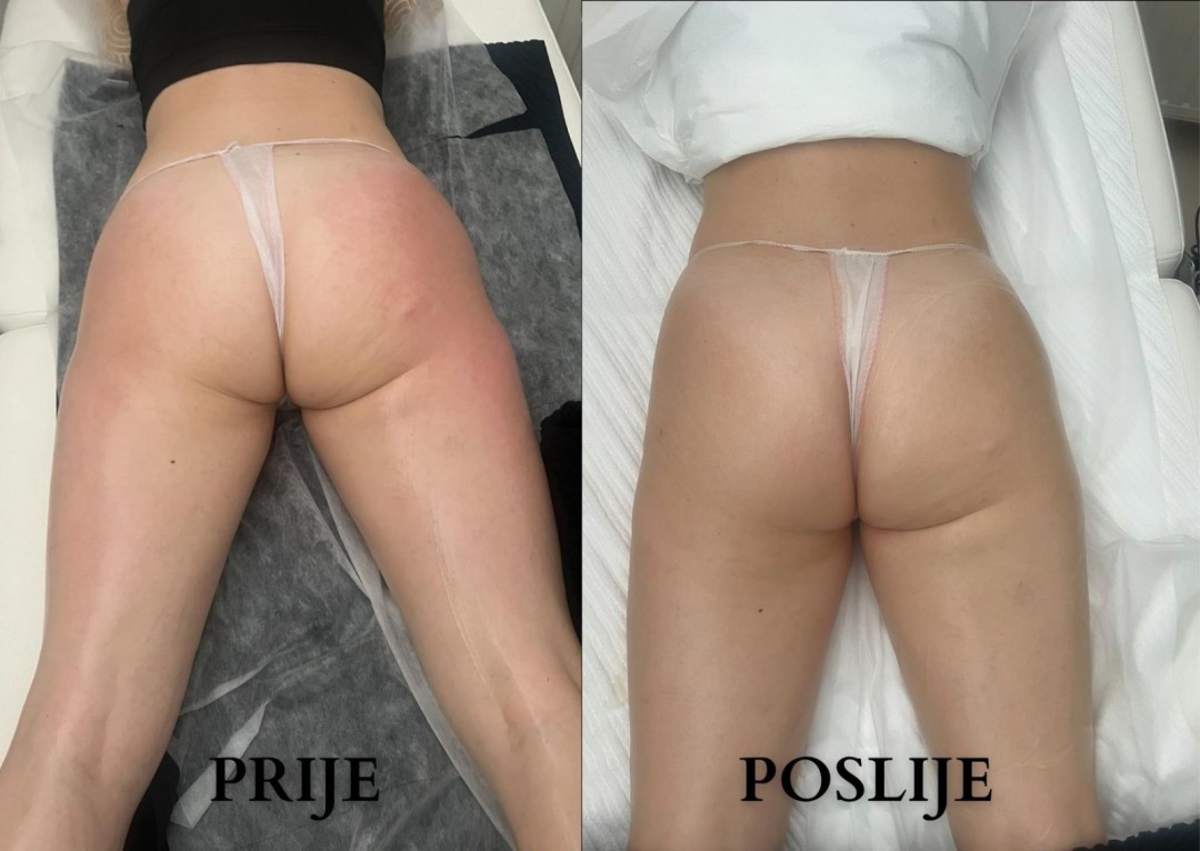 Cleopatra #zagreb Anticelulit masaža Maderoterapija 45 minuta - paket od 10 tretmana + 2 gratis limfne drenaže