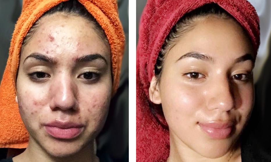 Medicinsko mehaničko čišćenje lica - problematična koža s akutnim upalnim stanjima - Cosmoderm & Centar Estetica, Zagreb Akne Lice Akne, Zagreb, Trnje