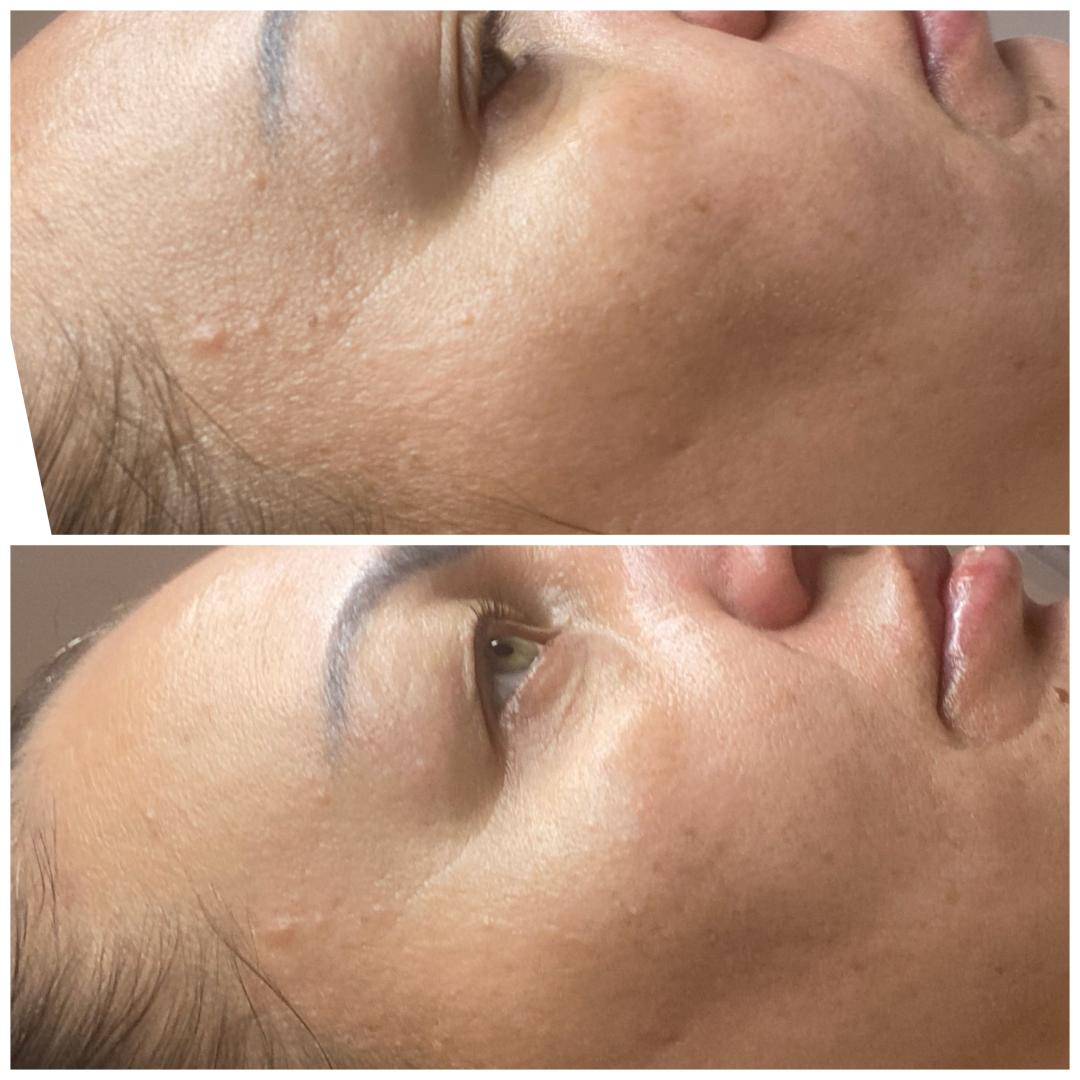 Nefertiti Studio #zagreb Tretman lica Hydra facial tretman