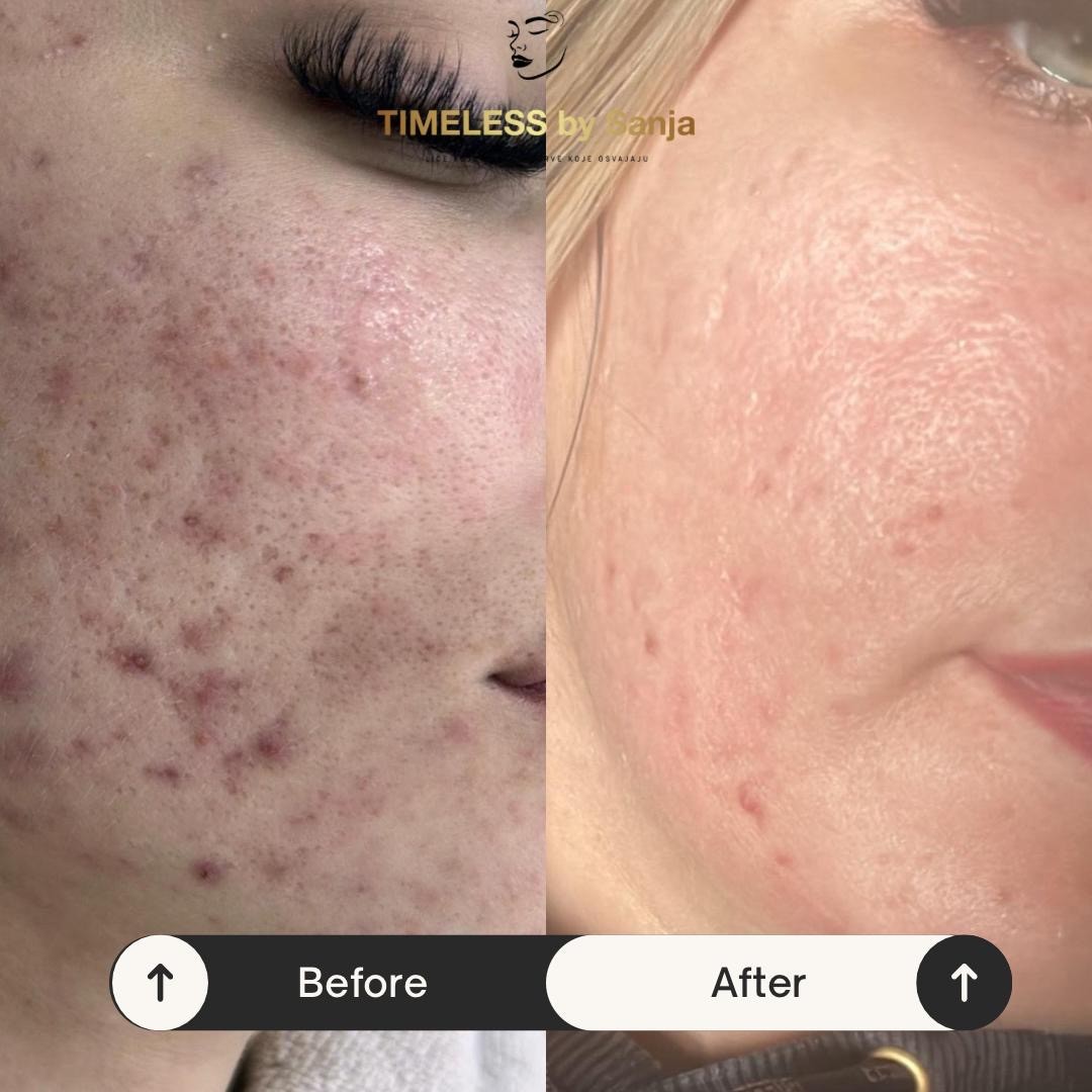 Timeless by Sanja #zagreb Tretman lica KRX - Green sea peel