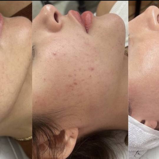 Angela #zagreb Uklanjanje akni na licu