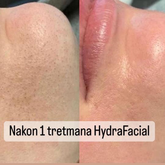 Perfect body beauty bar #zagreb Tretman lica Deluxe hydrafacial tretman lica