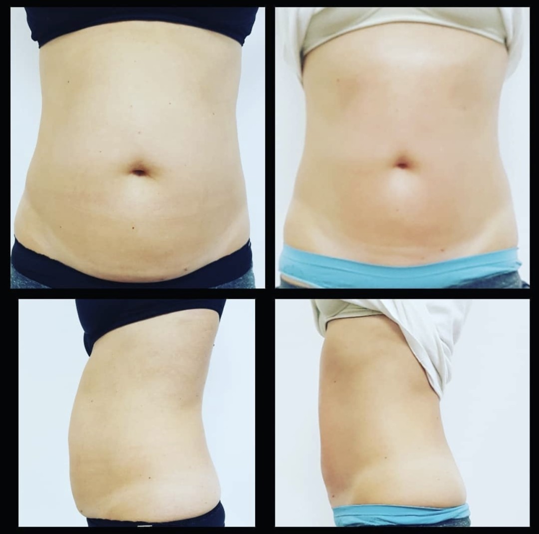 Beauty time by IM #zagreb Masaža za mršavljenje Maderoterapija - trbuha + body wrapping