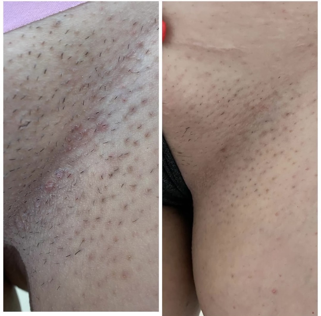 Nefertiti Studio #zagreb Laserska epilacija Laserska epilacija bikini zone - za dame