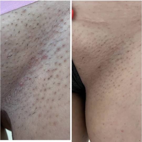 Nefertiti Studio #zagreb Laserska epilacija Laserska epilacija bikini zone - za dame