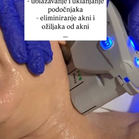 Perla #cakovec Tretman lica HIFU tretman cijelog lica + podbradka + vrata - paket od 2 tretmana