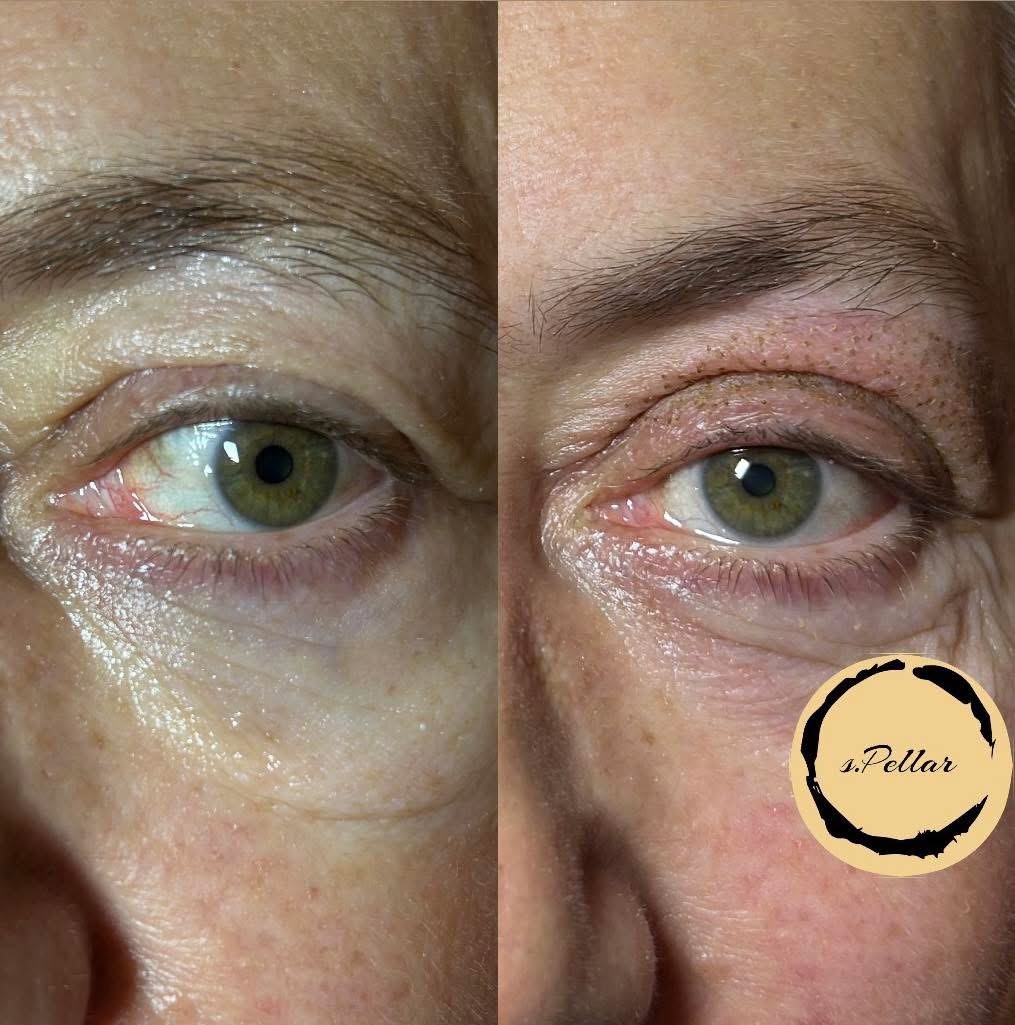 Spellar - Križ #kriz Lifting / zatezanje kože Plasma pen - podizanje + zatezanje kapaka