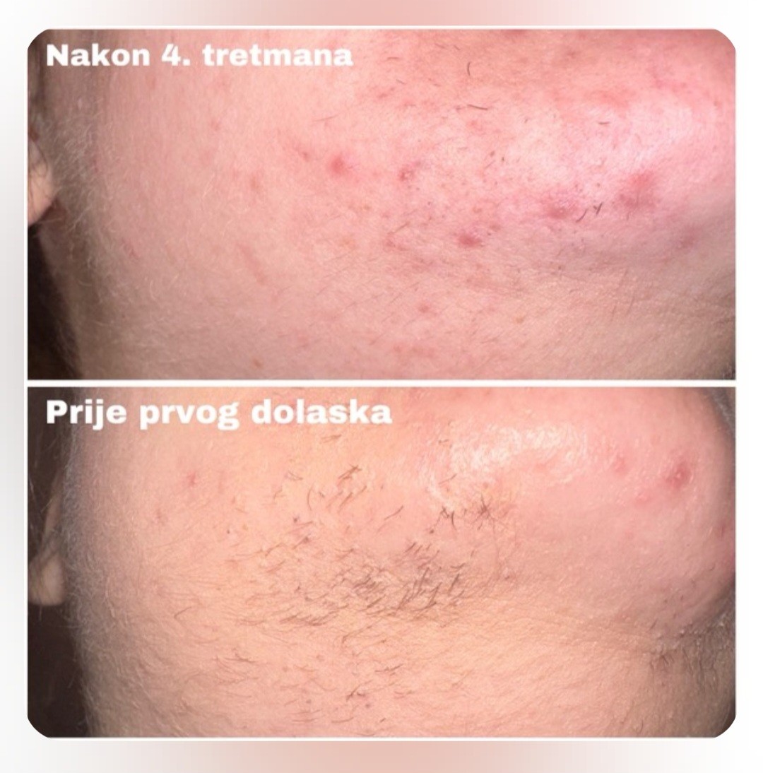 S M Beauty Bloom #zadar Laserska epilacija Laserska epilacija brade