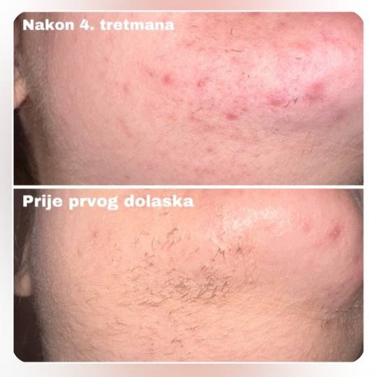 S M Beauty Bloom #zadar Laserska epilacija Laserska epilacija brade