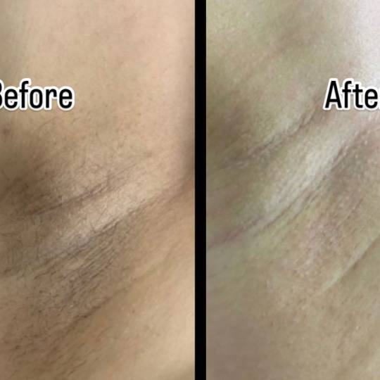 Angela #zagreb Laserska epilacija Laserska epilacija bikini zone + pazuha - za dame Laserska epilaci