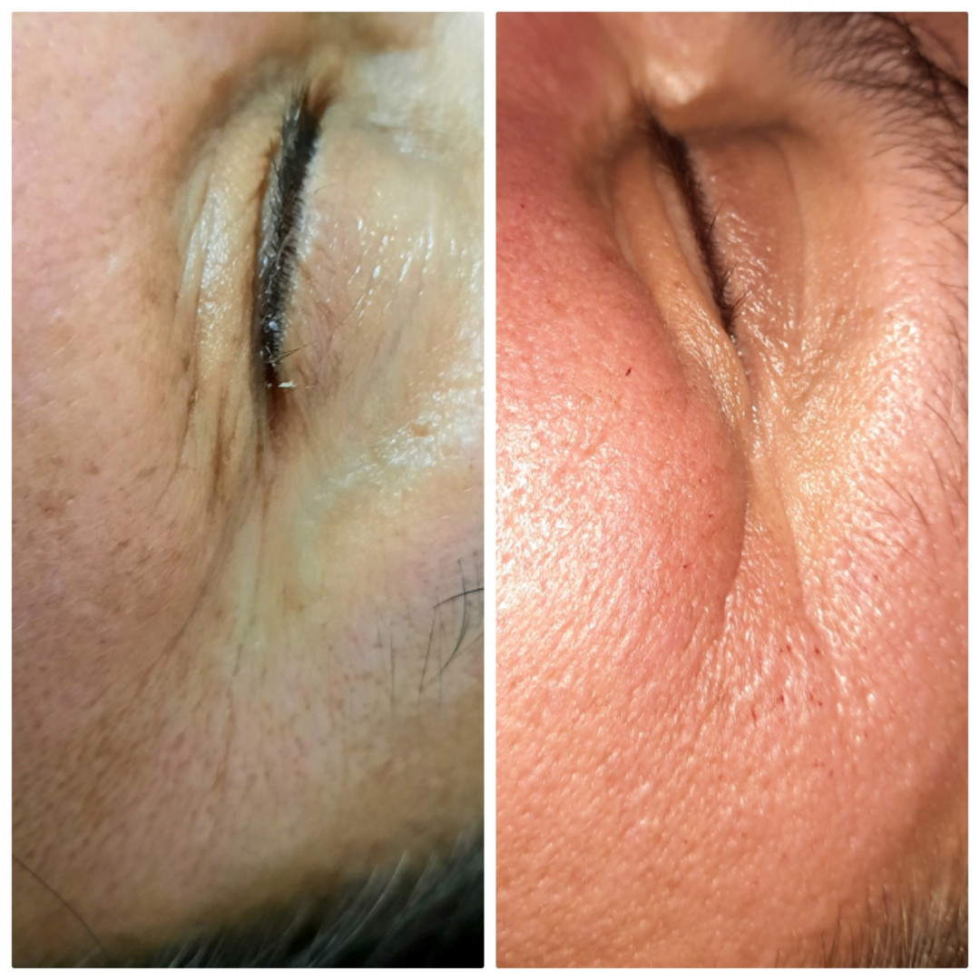 Melanis i Silueta studio za njegu lica i tijela #zagreb Tretman lica Mezoterapija lica + dermaroler - 5 tretmana